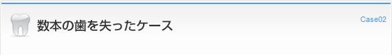 数本の歯を失ったケース